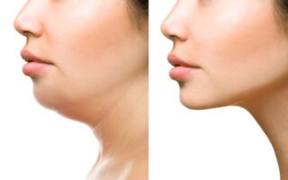 How to get Rid of Double Chin Naturally